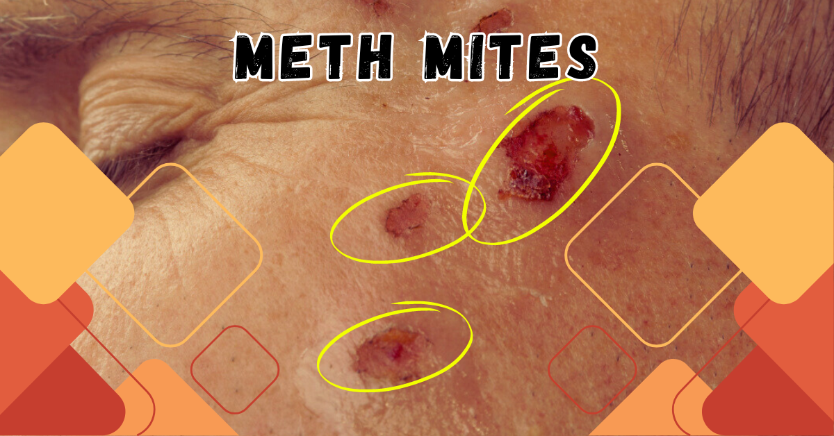 meth mites