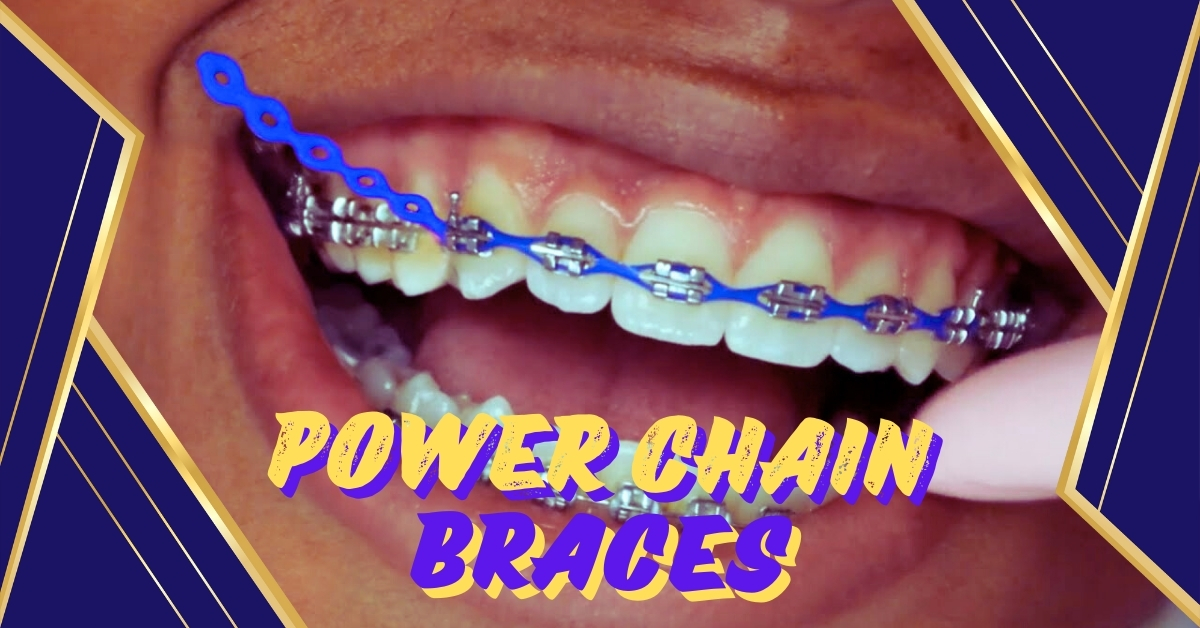 power chain braces